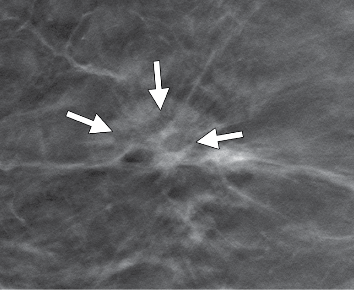 Invasive carcinoma in a 72-year-old woman, screening DBT image